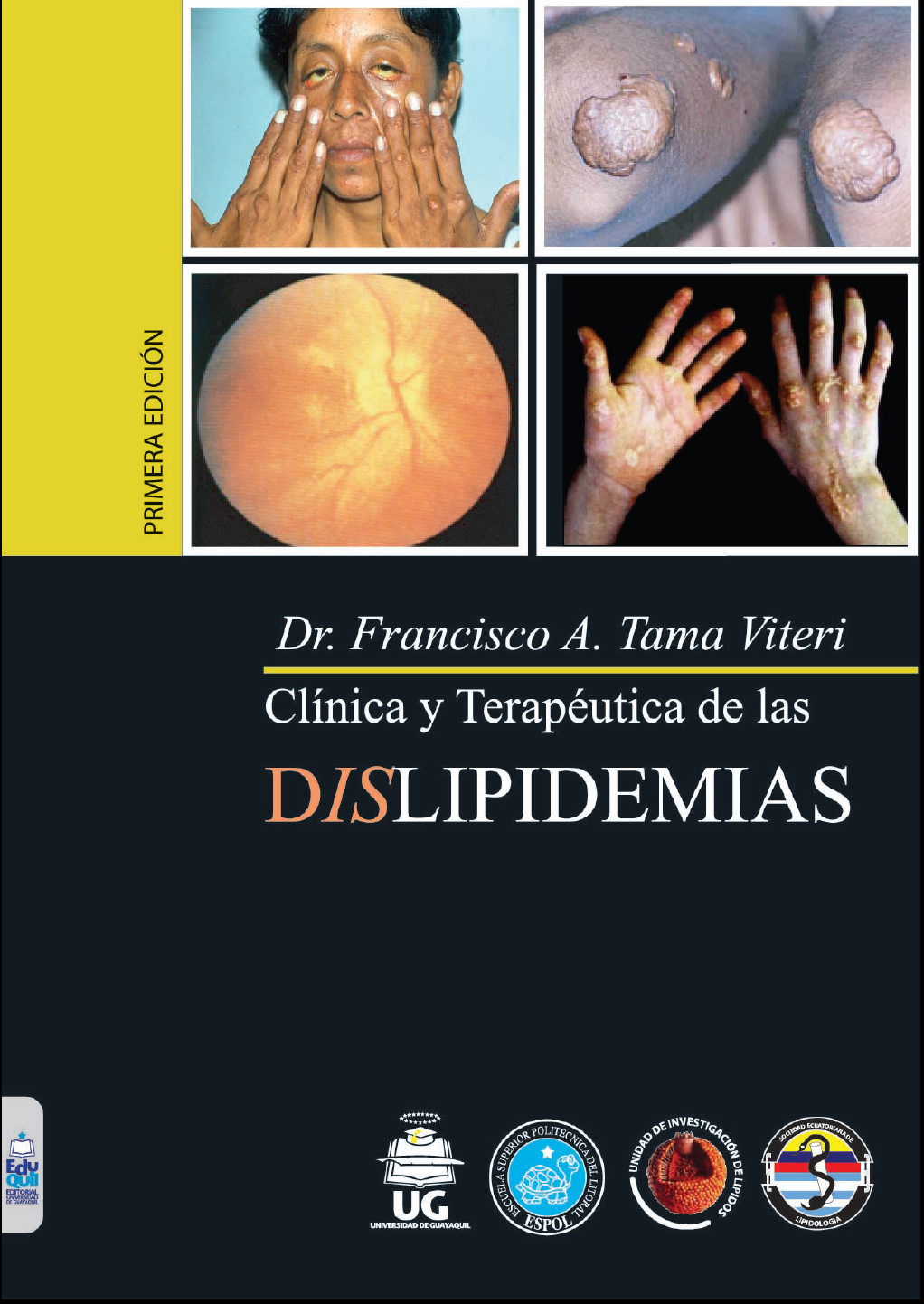 Clínica y Terapéutica de las Dislipidemias